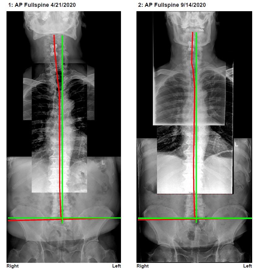 AP full spine comparative