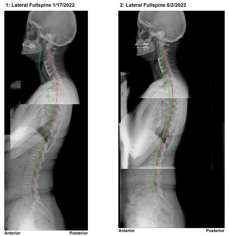 Alex Coleman before and after X-ray in one file