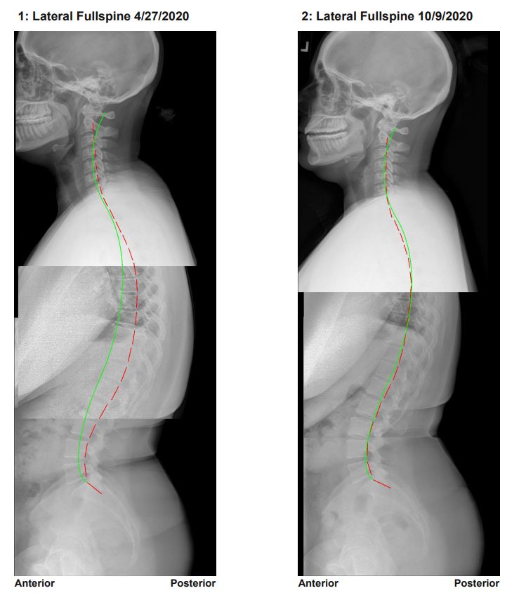 Full spine pre post X-rays patient 1