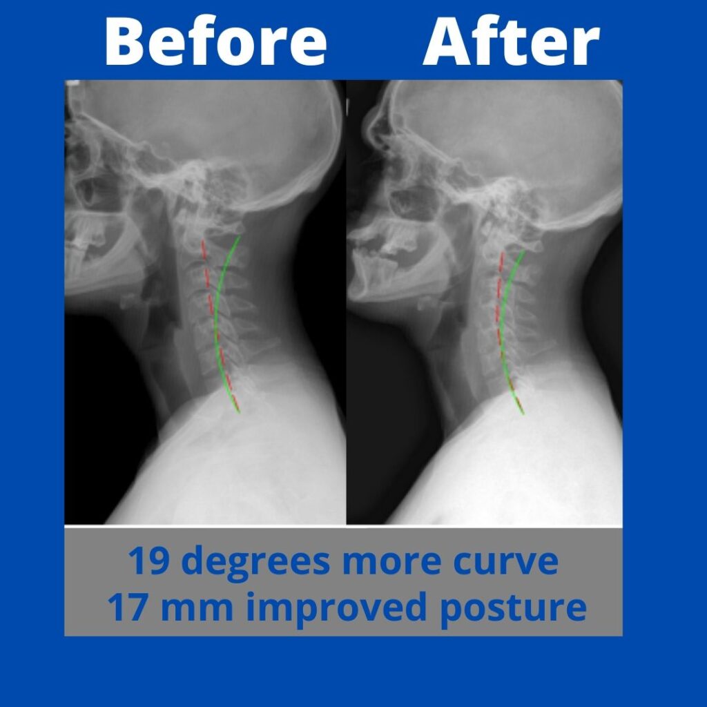 X-ray before after